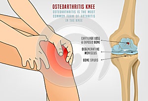 Osteoarthritis Knee Poster