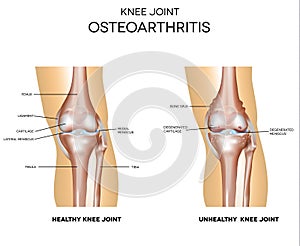 Osteoarthritis and normal joint