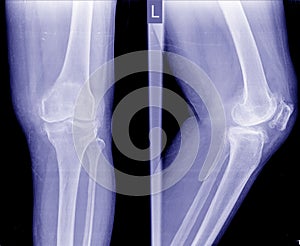 Osteoarthritis OA knee . film x-ray APand lateral view of knee show narrow joint space