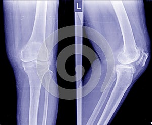 Osteoarthritis OA knee . film x-ray APand lateral view of knee show narrow joint space photo