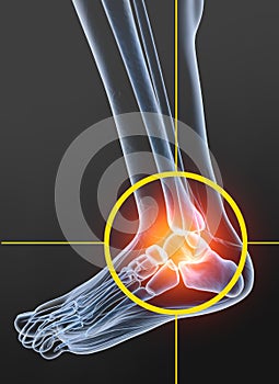 Osteoarthritis, painful ankle joint, 3D illustration