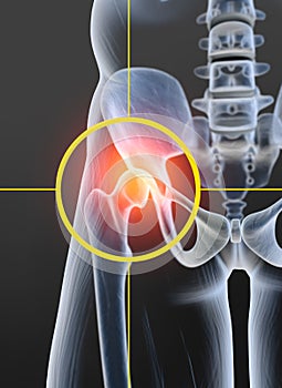Osteoarthritis, painful hip joint, 3D illustration