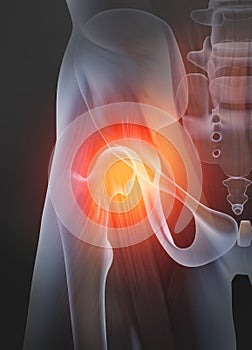 Osteoarthritis, painful hip joint, 3D illustration