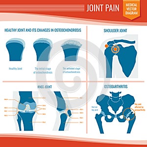 Osteoarthritis and rheumatism joint pain medical vector infographic photo