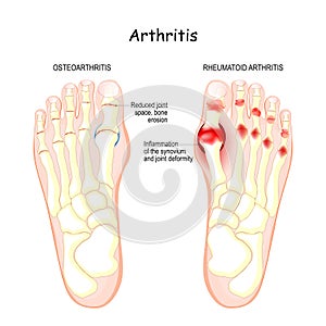 Osteoarthritis, rheumatoid arthritis, and posttraumatic arthritis