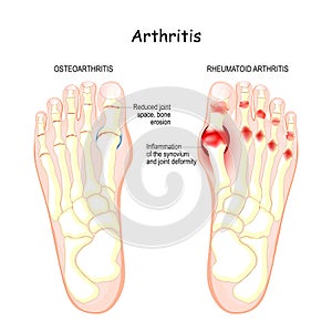 Osteoarthritis, rheumatoid arthritis, and posttraumatic arthritis photo
