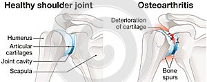 Osteoarthritis of the shoulder joint