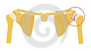 Osteoarthritis of the shoulder joint, degeneration of joint cartilage and the underlying bone. Vector illustration, flat design