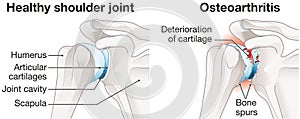 Osteoarthritis of the shoulder joint photo