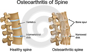 Osteoarthritis of Spine