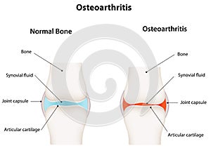 Osteoarthritis Synovial Joint