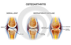 Osteoarthritis, unhealthy joint