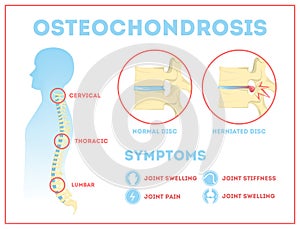 Osteochondrosis anatomical infographic. Lumbar, cervical and thoracic photo