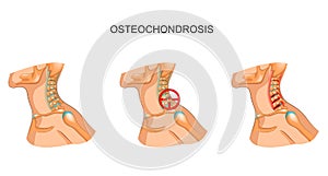 Osteochondrosis of the cervical vertebrae photo