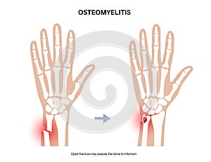 Osteomyelitis of arm