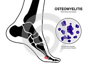 Osteomyelitis of feet