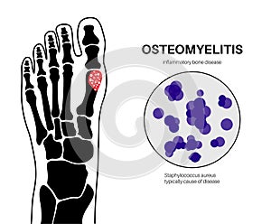 Osteomyelitis of feet