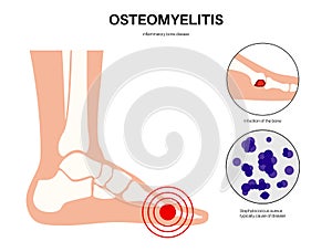 Osteomyelitis of feet