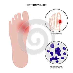 Osteomyelitis of feet