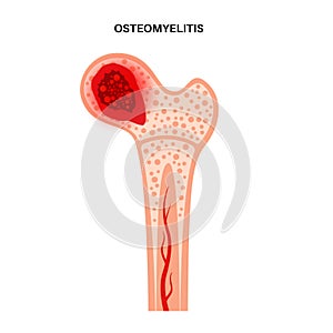 Osteomyelitis of hip