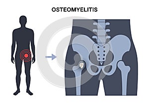 Osteomyelitis of hip