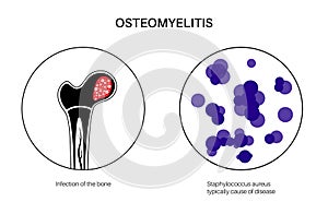 Osteomyelitis of hip