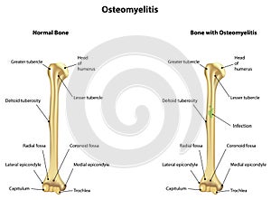 Osteomyelitis Infection