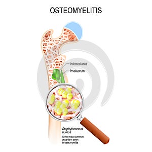 Osteomyelitis is infection in the bone. Close-up bacteria Staphylococcus aureus that caused this disease. Vector diagram shows