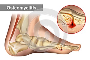 Osteomyelitis is an infection of bone. Diagram shows osteomyelitis of a humans foot bone.