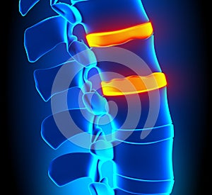 Osteophyte Formation Disc Degeneration photo