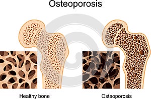 Osteoporosis