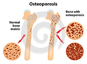 Osteoporosi 