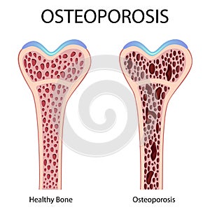 Osteoporosis