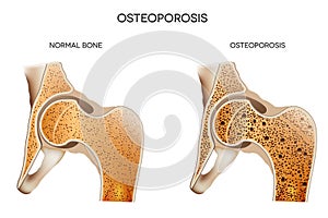 Osteoporosis