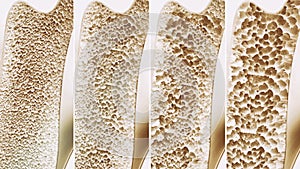 Osteoporosis 4 stages - 3d rendering