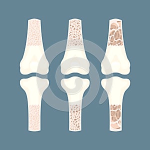 Osteoporosis bone density loss disease medical infographics