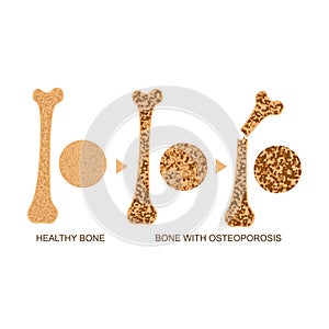 Osteoporosis Bone Infographics Concept Card Poster. Vector