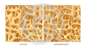 Osteoporosis
