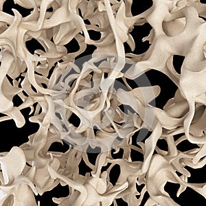 Osteoporosis bone structure