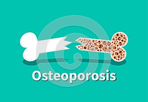 Osteoporosis, Bone structure in vector art