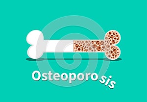 Osteoporosis, Bone structure in vector design