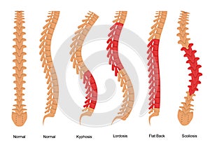 Osteoporosis Bone Types Infographics Concept Card Poster. Vector