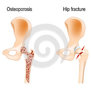 Osteoporosis that caused of Hip fracture