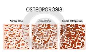 Osteoporosis - is a disease of bones that leads to an increased