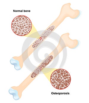 Osteoporosis. disease of bones photo