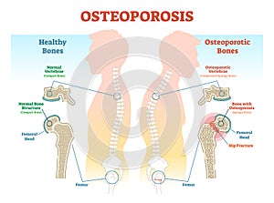 Osteoporosis examples vector illustration diagram with bone density.