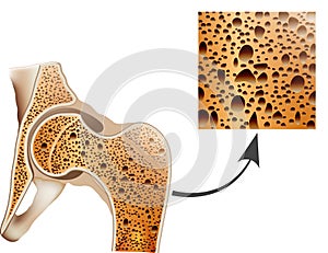 Osteoporosis in femur bone photo