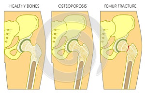 Osteoporosis1_with femur fracture and without dislocation 1