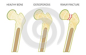 Osteoporosis 3_with femur fracture and dislocation