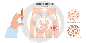 Osteoporosis medical poster